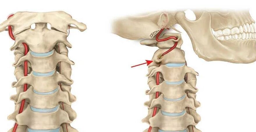vertebral artery syndrome