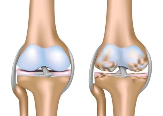 What is gonarthrosis