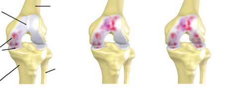 degree of arthrosis