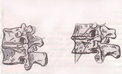 The intervertebral disc is healthy and with lumbar osteochondrosis