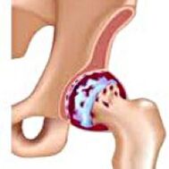 Hip Articulation Arthrosis
