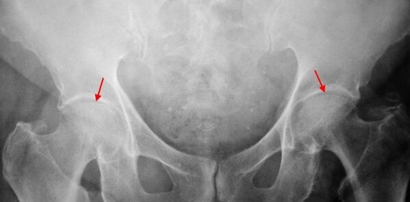 Sustling of double -sided cooksartrosis of the joint gap, sclerosis of joint surfaces