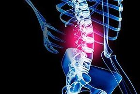 osteochondrosis of the lumbar spine