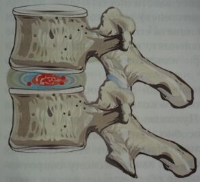 First stage of osteochondrosis