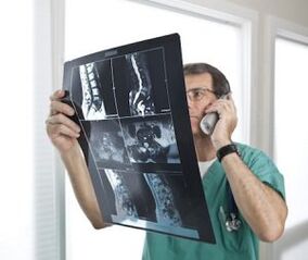 Myelography for diagnosing osteochondrosis and intervertebral hernias