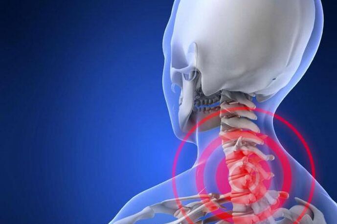 Acute neck pain is an early symptom of cervical osteochondrosis